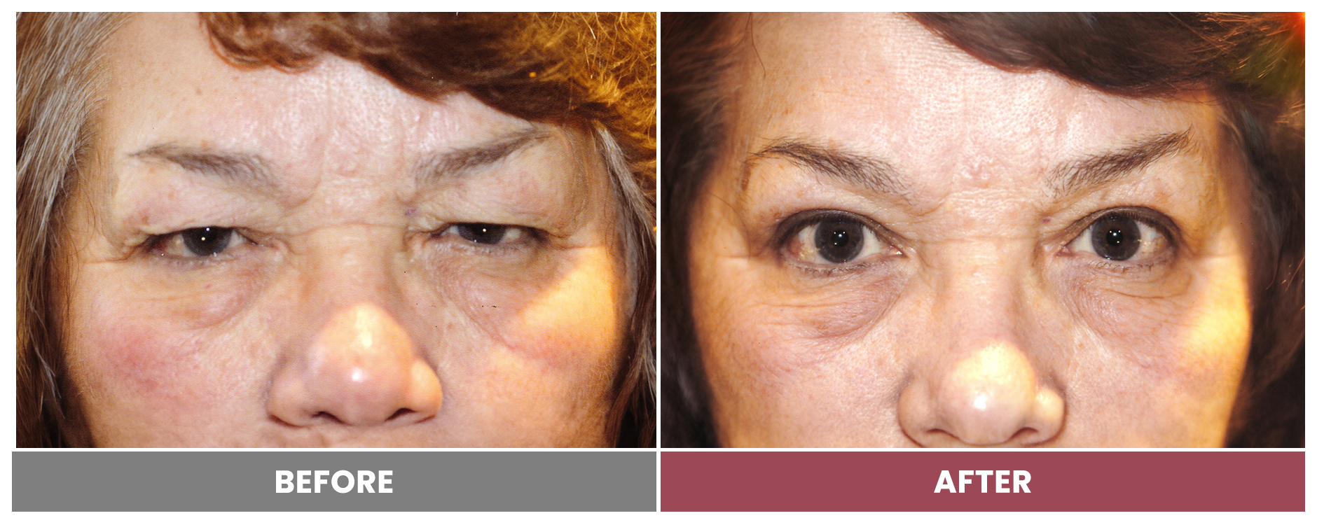 Upper Blepharoplasty - Case 89
